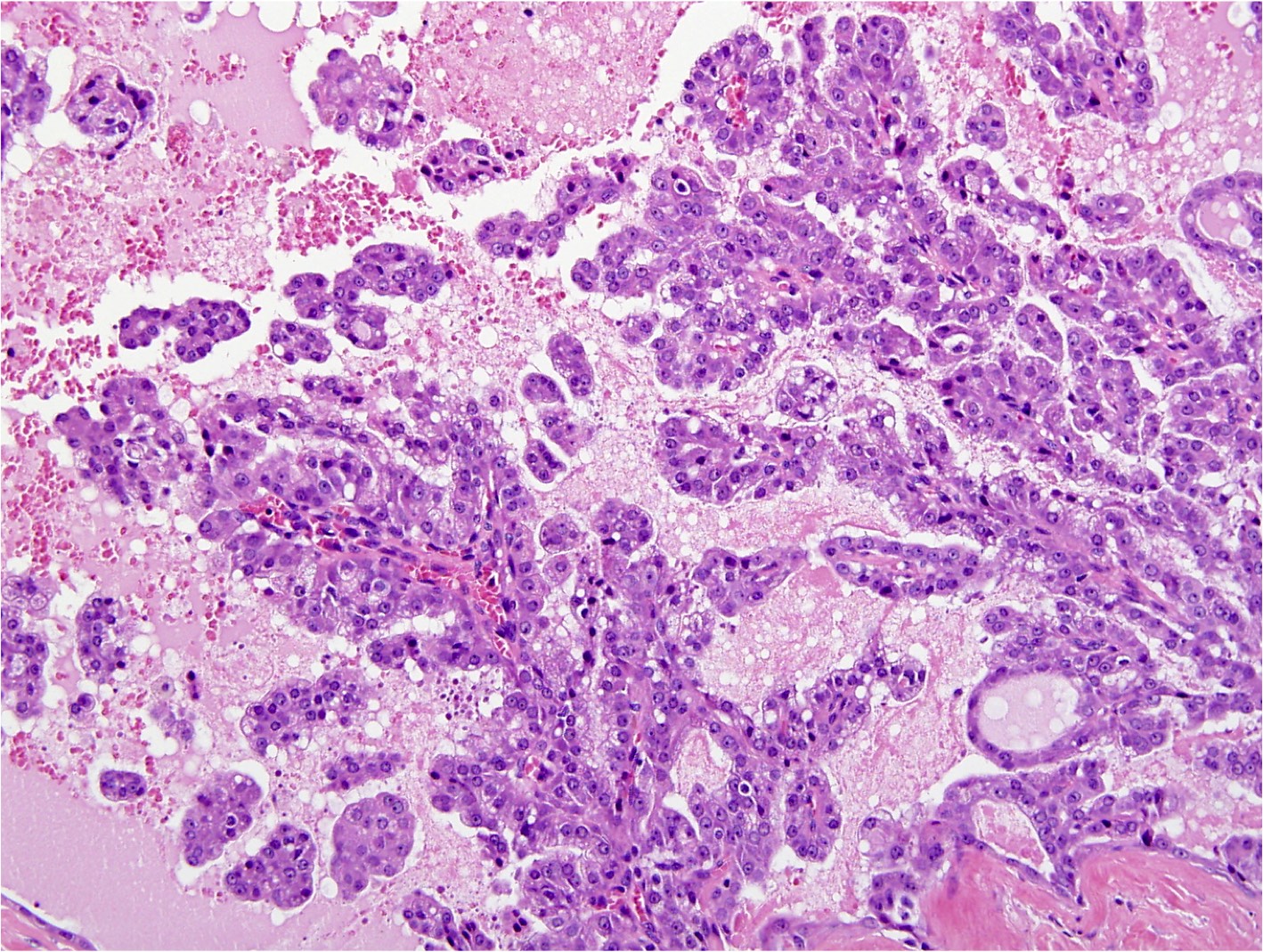 Secretory Carcinoma (SC) - Salivary Gland Cancer UK